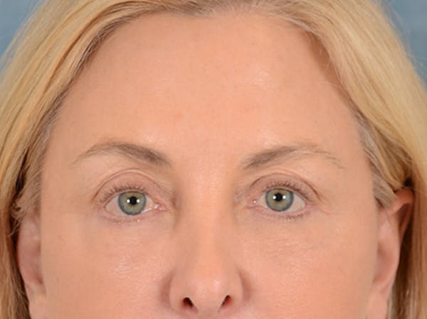 Eyelid Lift Before & After Gallery - Patient 146899125 - Image 2