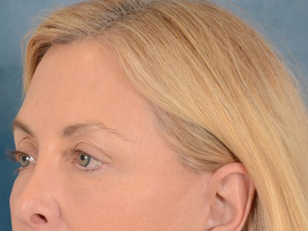 Eyelid Lift Before & After Gallery - Patient 146899125 - Image 4