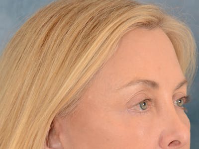 Eyelid Lift Before & After Gallery - Patient 146899125 - Image 6