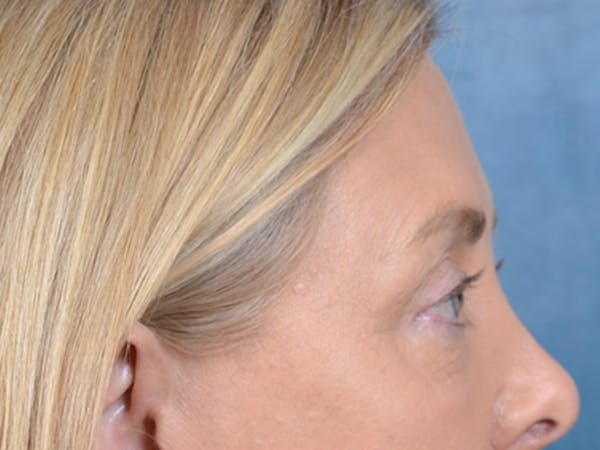 Eyelid Lift Before & After Gallery - Patient 146899125 - Image 7