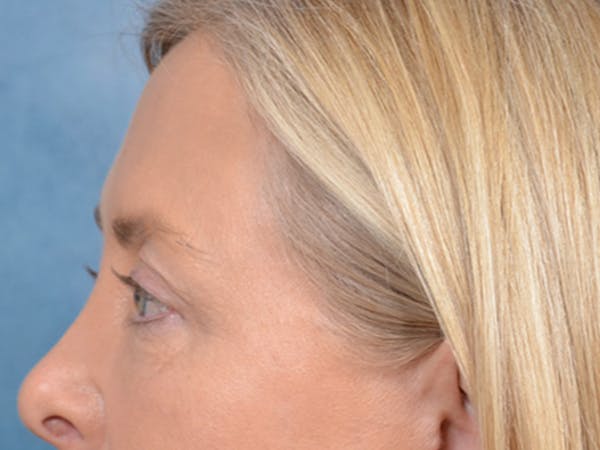 Eyelid Lift Before & After Gallery - Patient 146899125 - Image 9