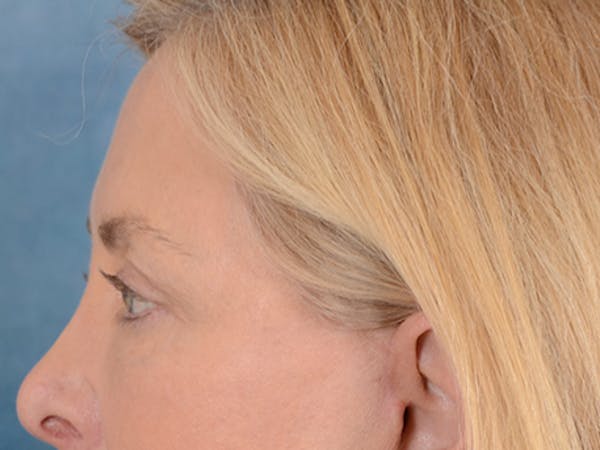Eyelid Lift Before & After Gallery - Patient 146899125 - Image 10