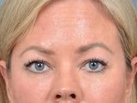 Eyelid Lift Before & After Gallery - Patient 148827543 - Image 1