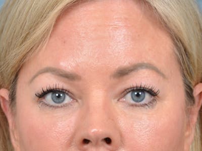 Eyelid Lift Before & After Gallery - Patient 148827543 - Image 1