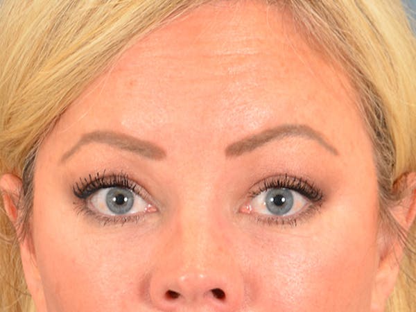 Eyelid Lift Before & After Gallery - Patient 148827543 - Image 2