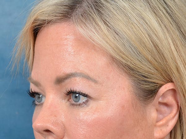 Eyelid Lift Before & After Gallery - Patient 148827543 - Image 3