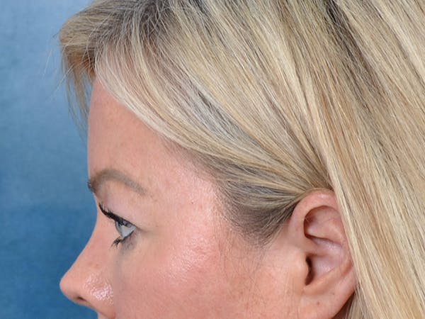 Eyelid Lift Before & After Gallery - Patient 148827543 - Image 9