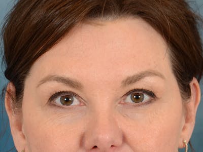 Eyelid Lift Before & After Gallery - Patient 169465723 - Image 1