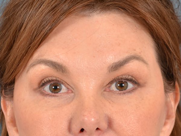 Eyelid Lift Before & After Gallery - Patient 169465723 - Image 2