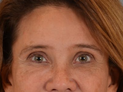 Eyelid Lift Before & After Gallery - Patient 635760 - Image 2