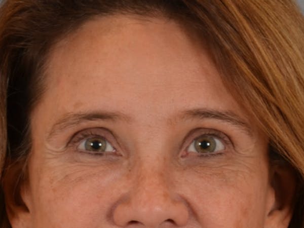 Eyelid Lift Before & After Gallery - Patient 635760 - Image 2
