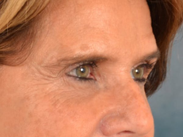 Eyelid Lift Before & After Gallery - Patient 635760 - Image 3