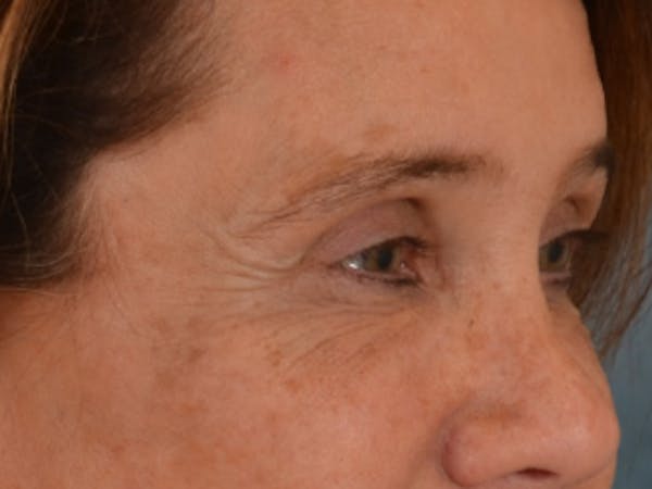 Eyelid Lift Before & After Gallery - Patient 635760 - Image 4