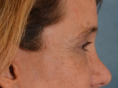Eyelid Lift Before & After Gallery - Patient 635760 - Image 6