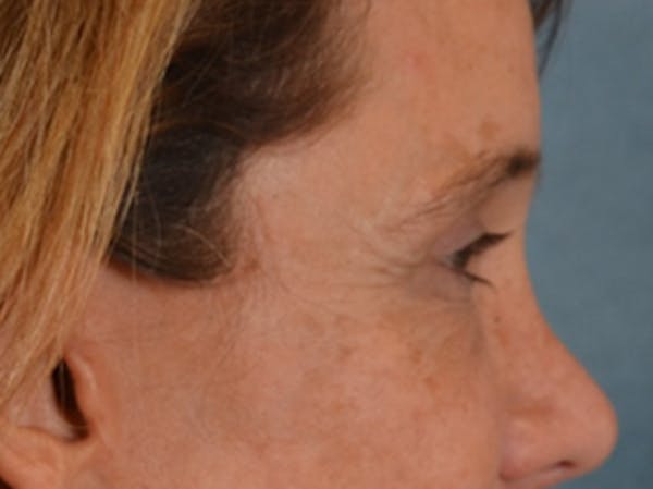 Eyelid Lift Before & After Gallery - Patient 635760 - Image 6