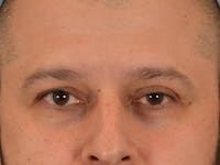 Eyelid Lift Before & After Gallery - Patient 138692 - Image 1