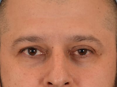 Eyelid Lift Before & After Gallery - Patient 138692 - Image 1