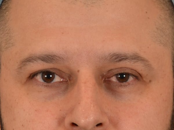 Eyelid Lift Before & After Gallery - Patient 138692 - Image 1