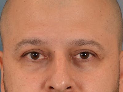 Eyelid Lift Before & After Gallery - Patient 138692 - Image 2