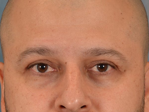 Eyelid Lift Before & After Gallery - Patient 138692 - Image 2