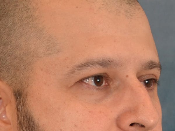 Eyelid Lift Before & After Gallery - Patient 138692 - Image 3
