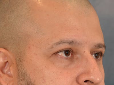 Eyelid Lift Before & After Gallery - Patient 138692 - Image 4