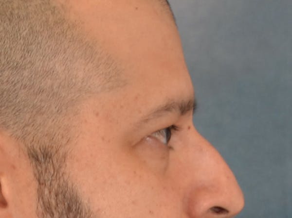 Eyelid Lift Before & After Gallery - Patient 138692 - Image 5