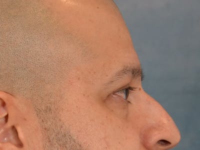 Eyelid Lift Before & After Gallery - Patient 138692 - Image 6