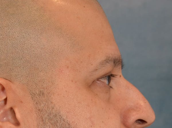 Eyelid Lift Before & After Gallery - Patient 138692 - Image 6