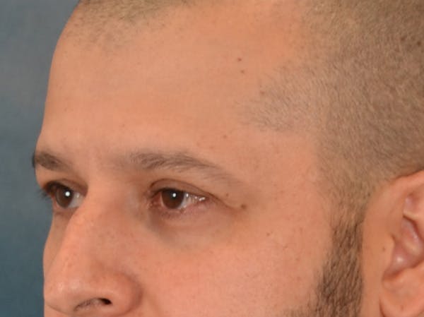 Eyelid Lift Before & After Gallery - Patient 138692 - Image 7