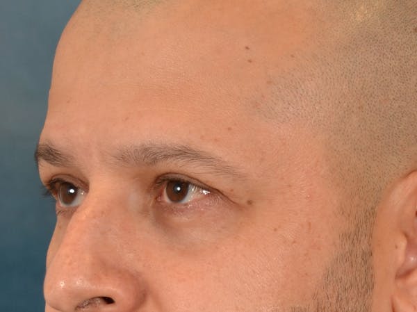 Eyelid Lift Before & After Gallery - Patient 138692 - Image 8