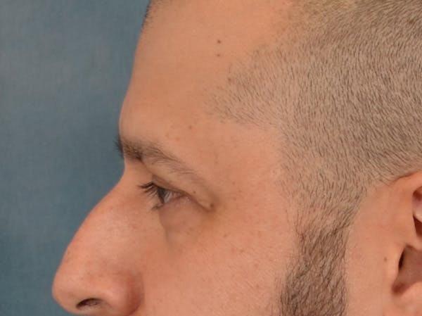 Eyelid Lift Before & After Gallery - Patient 138692 - Image 9