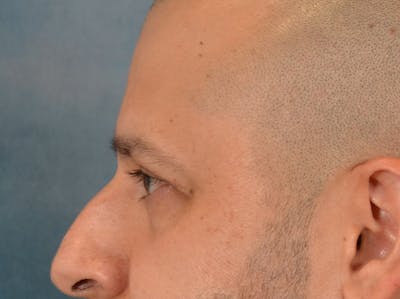 Eyelid Lift Before & After Gallery - Patient 138692 - Image 10