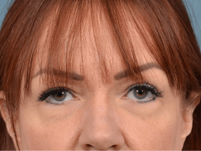 Eyelid Lift Before & After Gallery - Patient 148072054 - Image 1