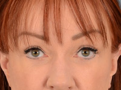 Eyelid Lift Before & After Gallery - Patient 148072054 - Image 2