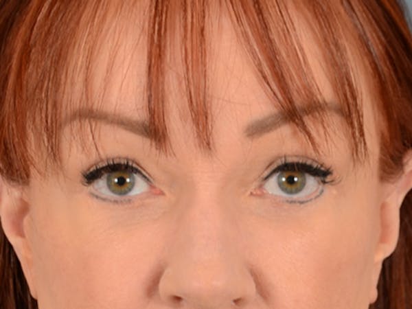 Eyelid Lift Before & After Gallery - Patient 148072054 - Image 2