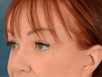 Eyelid Lift Before & After Gallery - Patient 148072054 - Image 4