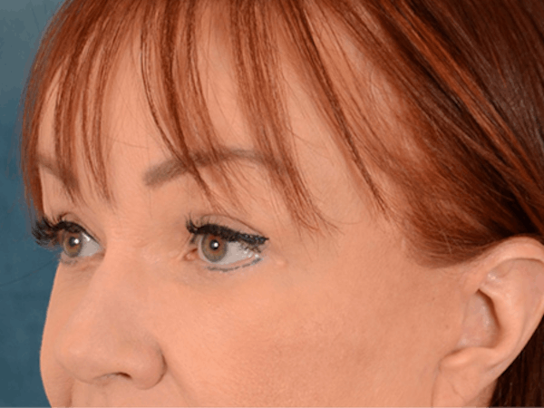 Eyelid Lift Before & After Gallery - Patient 148072054 - Image 4