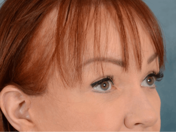 Eyelid Lift Before & After Gallery - Patient 148072054 - Image 6