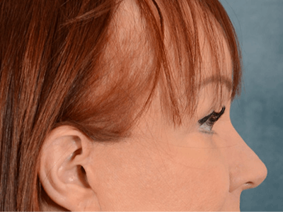 Eyelid Lift Before & After Gallery - Patient 148072054 - Image 8