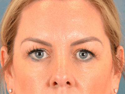 Eyelid Lift Before & After Gallery - Patient 194708 - Image 1