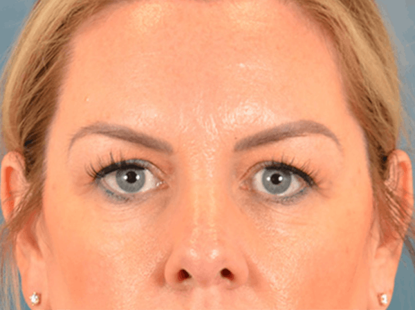 Eyelid Lift Before & After Gallery - Patient 194708 - Image 1