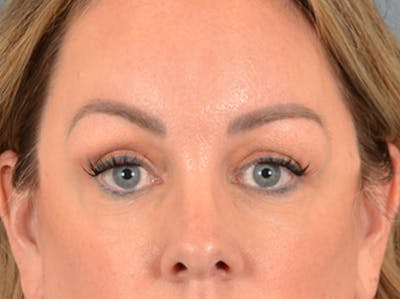 Eyelid Lift Before & After Gallery - Patient 194708 - Image 2