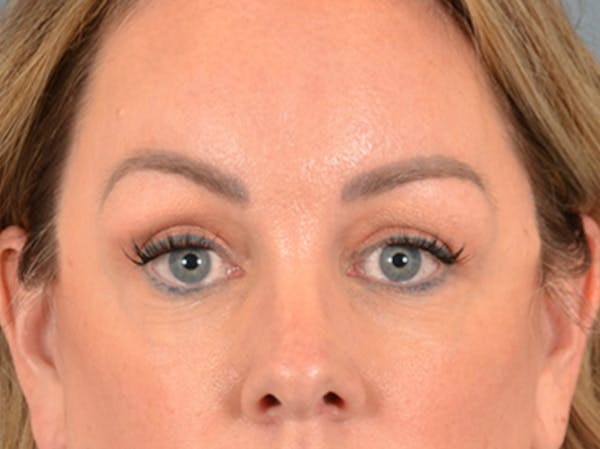 Eyelid Lift Before & After Gallery - Patient 194708 - Image 2
