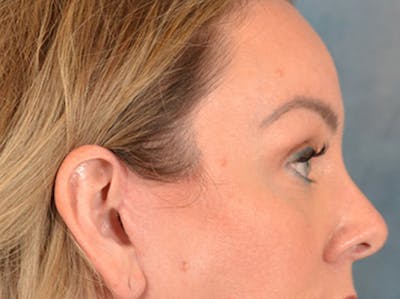 Eyelid Lift Before & After Gallery - Patient 194708 - Image 6