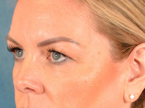 Eyelid Lift Before & After Gallery - Patient 194708 - Image 7