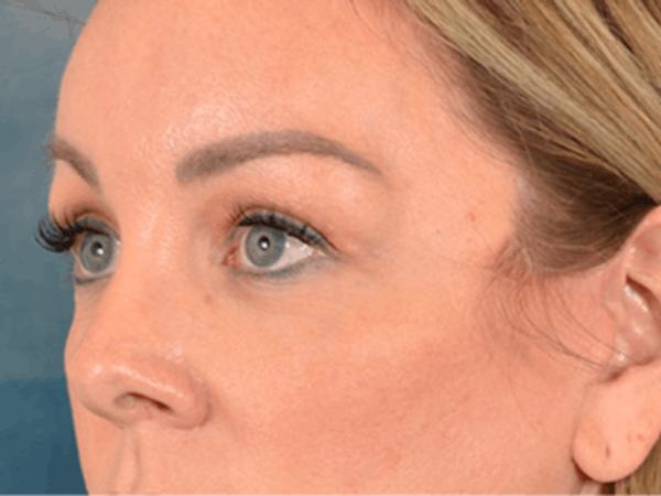 Eyelid Lift Before & After Gallery - Patient 194708 - Image 8