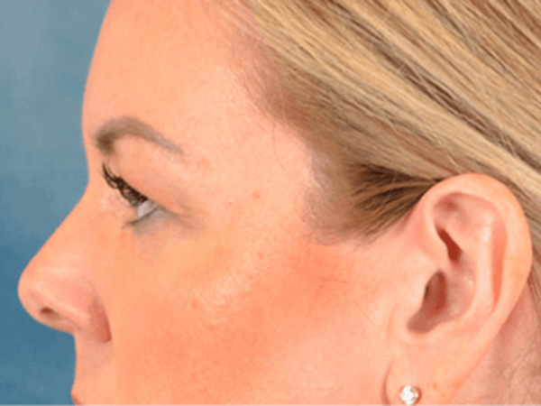 Eyelid Lift Before & After Gallery - Patient 194708 - Image 9