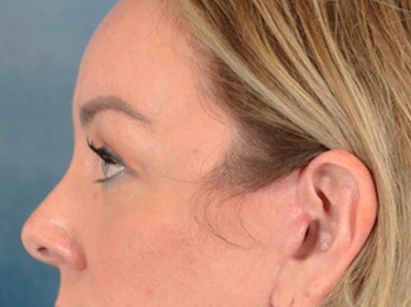 Eyelid Lift Before & After Gallery - Patient 194708 - Image 10