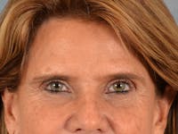 Eyelid Lift Before & After Gallery - Patient 635760 - Image 1